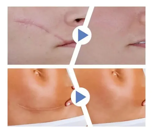 Cinta Cicatriz Cesarea Gaon Heridas Cuerpo Cirugia Queloide