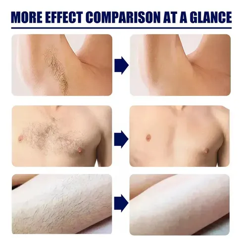 Aj 2×crema De Depilación Permanente-removedor De Barba Y