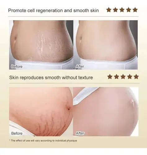 +crema Para Eliminar Estrías, Antiarrugas, Antienvejecimiento.