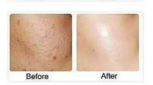 Ácido Salicilico,crema,serum O Solución.acne Y Piel Seborrei
