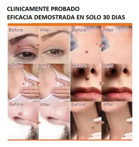 Crema para Eliminar Verrugas del Cuerpo con Propóleo y Fórmula Natural de 10 mL