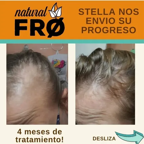 Loción Capilar Naturalfro Crecimiento Calvicie Caida X 300ml