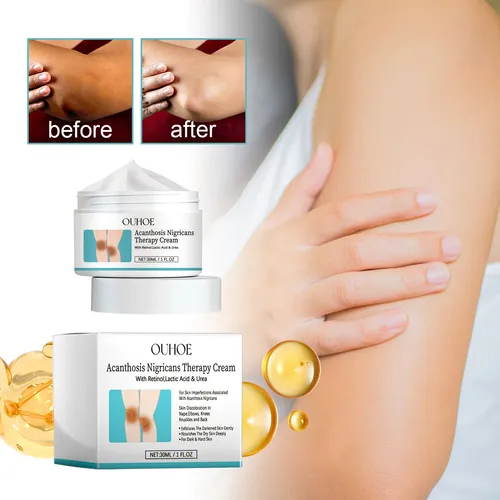 La Crema Reutilizable Para Dermatomas Con Puntos Negros Ouho
