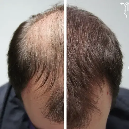 Fibras Capilares De Keratina 28gr Frasco Immetee Pelo Polvo