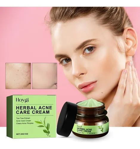 Crema Herbal Para El Acné Hoygi Para Una Piel Clara Y Suave