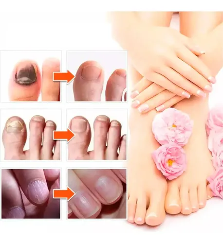 Tratamiento Uñas Hongos Piel Seca Picazón Natural Micosis