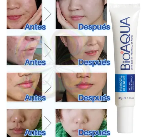 Crema Facial Para Puntos Negros, Antiacné, Cicatrices Y Poro