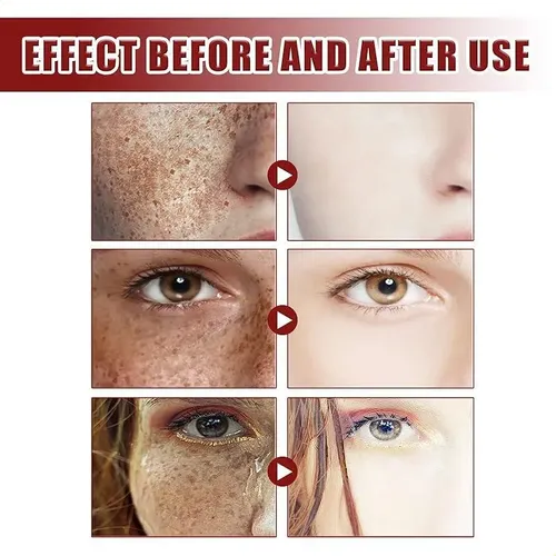 Crema Para Manchas Oscuras En La Cara, Cremas Para Quitar