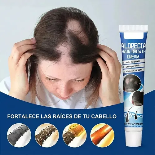 Tratamiento Alopecia Areata Anticaída Cabello Natural