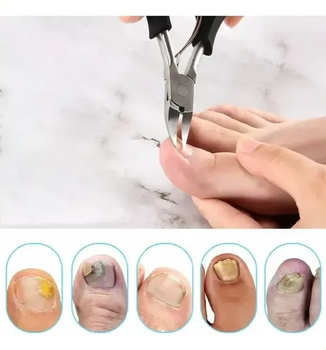 Cortauñas Para Uñas Gruesas Y Encarnadas, Kit 3 Piezas