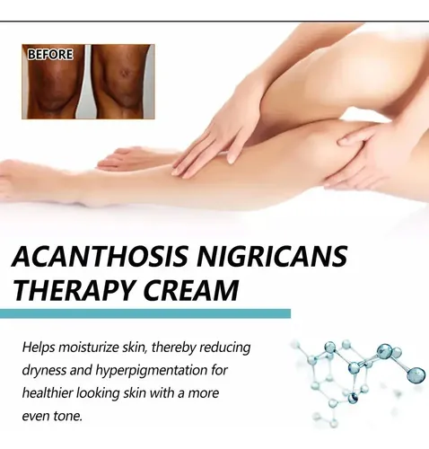 Hd Fixderma Nigrifix Crema Para Acantosis Nigricans Fbg,h