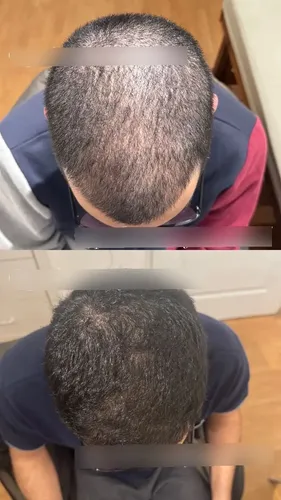 Loción Anticaida 5%, Fortalece, Crece Y Nutre El Cabello