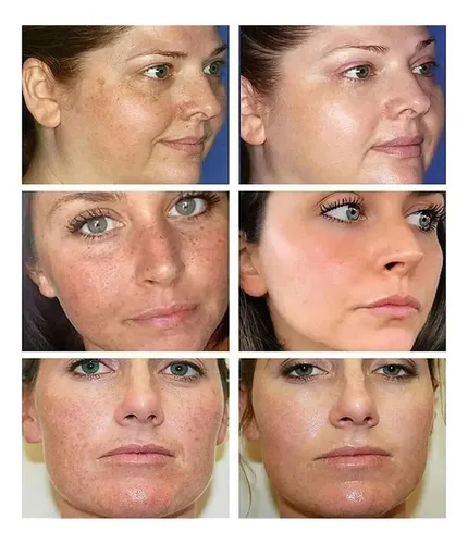 +crema Para Manchas Oscuras En La Cara, Cremas Para Quitar /