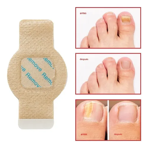 \\ Fc Parches Para Uñas Fúngicos 63pcs/caja De Parches Para