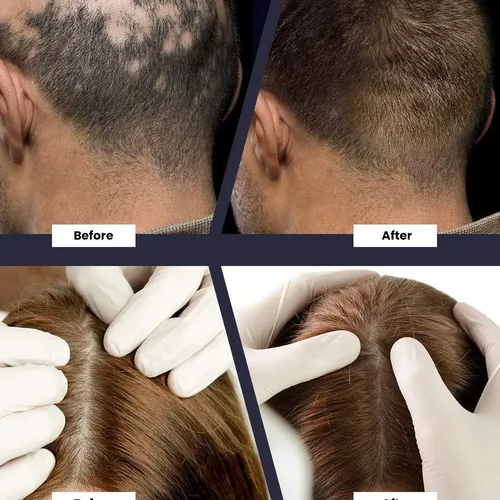 Sérum Para El Crecimiento Del Cabello Para Alopecia Seborrei