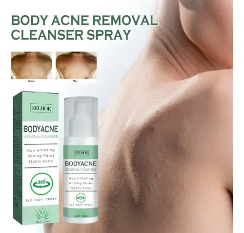 3×spray For Eliminar El Acné Corporal For Espalda, Cuello .