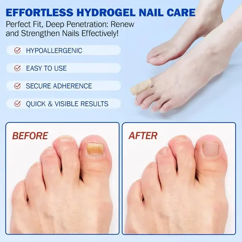 2 Cajas De Parches For Hongos En Las Uñas De Los Pies – 21