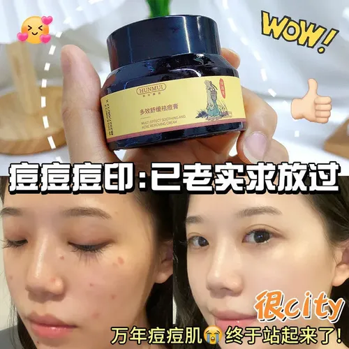 Crema Multiefecto Para El Acné Que Elimina Marcas Y Puntos N