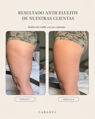 Aceite De Masaje Reafirmante Anticelulitis (oferta) X3