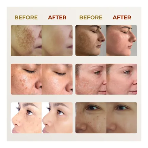 Abera Dark Spot For Face: Dark Spot Corrector Para Spot Sun