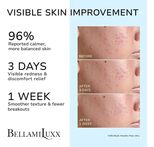 Crema De Tratamiento Del Acné Bellamiluxx Para Rostro Con 2% Acneica Día/noche