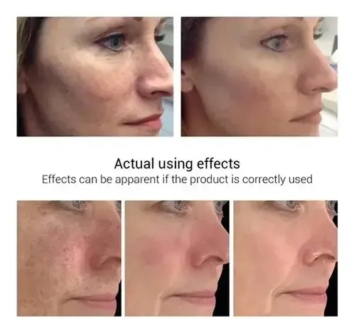 Crema Blanqueadora De Melasma Para Una Eliminación Eficaz