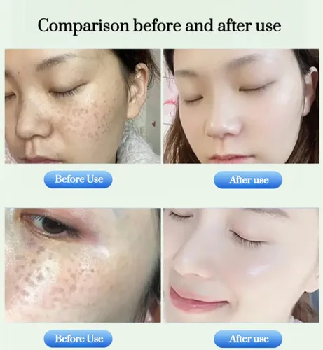 Crema Blanqueadora Antiarrugas Para Ojos Y Manchas