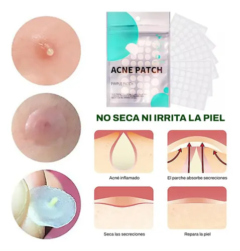 Parches Anti Acne Elimina Granitos Puntos Negros Grasa X72 Todo Tipo De Piel