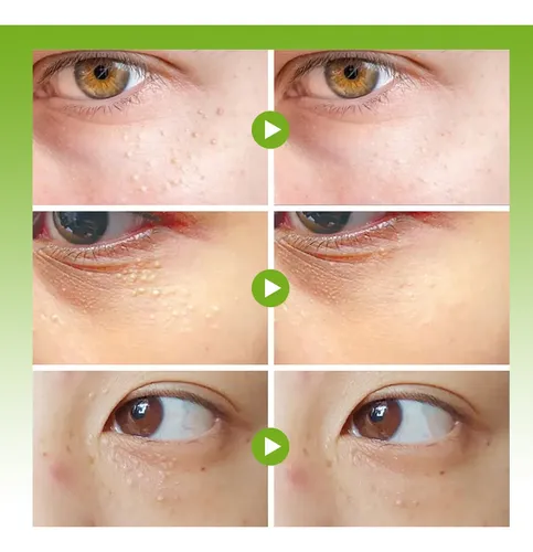 Pomada Contorno Ojos Vitamina Para Milium X2