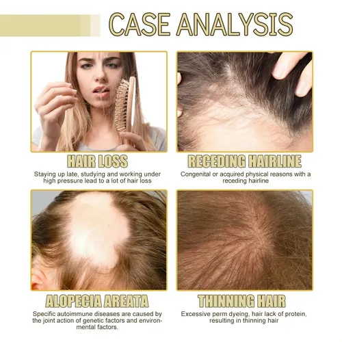 Aceite Capilar De Romero Para Un Cabello Suave, Sedoso Y Nut