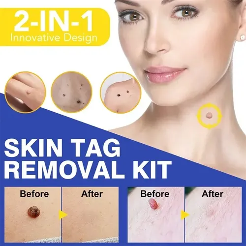 1 Set De Removedor De Verrugas Mole Tag Ii