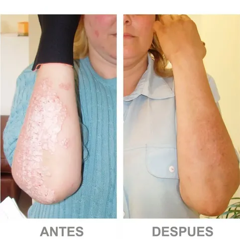 Dermabine Psor Crema 200g Para Piel Escamada Y Enrojecida