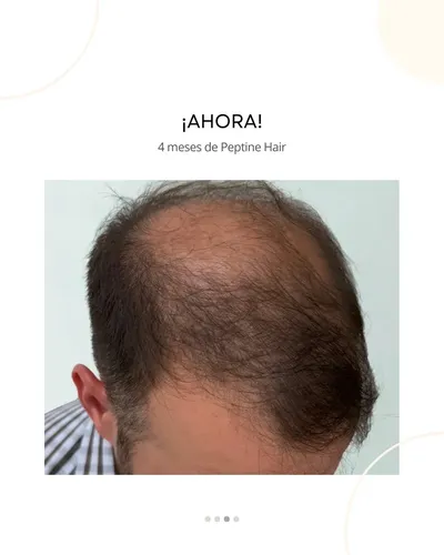 Peptine Hair Peptona Caída Cabello Bio-regenerador Capilar
