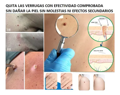Crema para Eliminar Verrugas del Cuerpo con Propóleo y Fórmula Natural de 10 mL