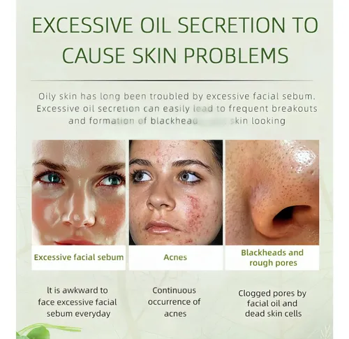 2026 2 Crema Herbal Antiacné Controla Granos -pls