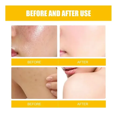 2×crema Para Tratar El Acné Combate El Acné Quístico Hormon Todo Tipo De Piel