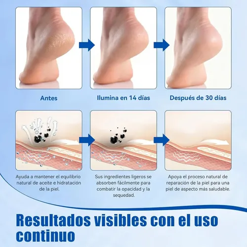 Exfoliante De Pies Hidratante Para Callos Y Durezas