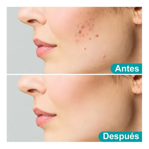 Creme Para Acne Trata A Acne No Rosto E No Corpo