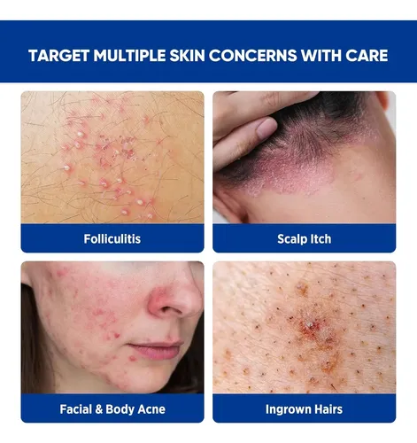Crema Antifoliculitis Y Acné Aosorw 100 G
