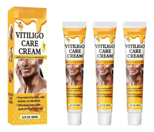 Crema Reparadora De Manchas Blancas Para El Vitíligo *3h