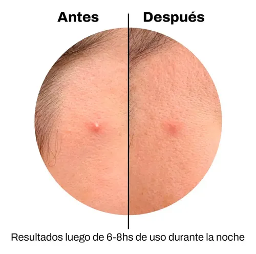 Parches Acne Tratamiento Rápido Absorción Espinillas X36 Tipo De Piel Todo Tipo De Piel