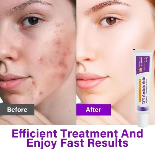 Cjw2026 Nueva Crema De Ácido Azelaico, Suero Facial Con