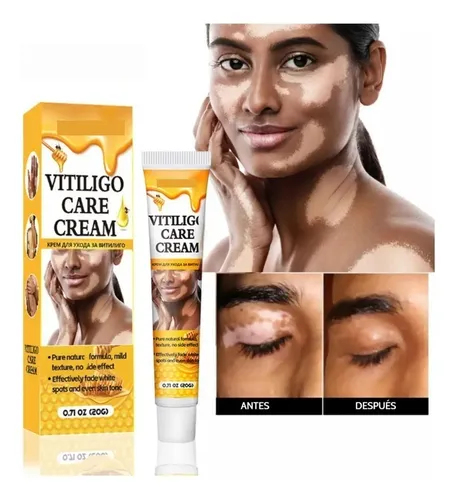 Crema Reparadora De Manchas Blancas Para El Vitíligo *3h