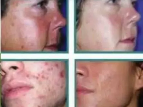 SEBUM CONTROL TREATMENT Idraet Dermopurity