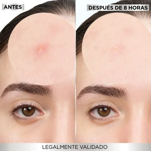 Parches Para Granos Anti Imperfecciones X22 Garnier