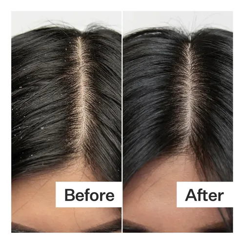 Exfoliante Para Cuero Cabelludo Act+ Acre Con Ácido Bha Proc