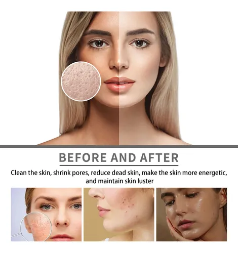 I Crema Blanqueadora Facial Para Cerrar Los Poros Abiertos Y