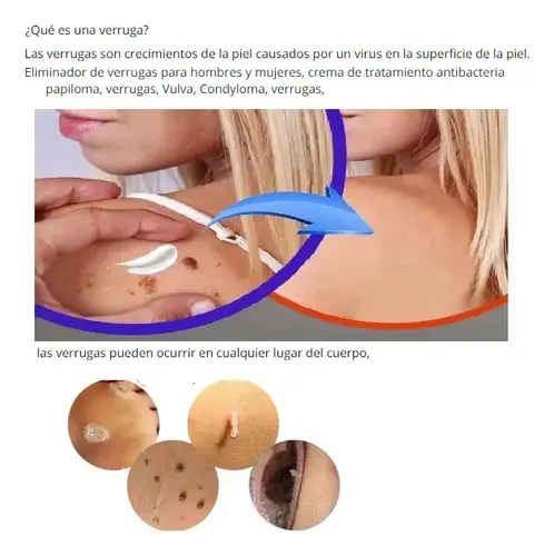 Crema Para Verrugas Zona Intima