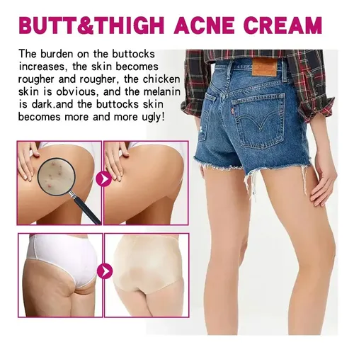 C Crema Para El Acné De Glúteos, Eliminación De Espinillas