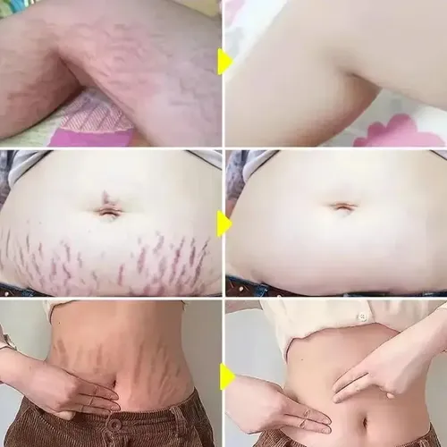 +crema Para Eliminar Estrías, Antiarrugas, Antienvejecimiento.